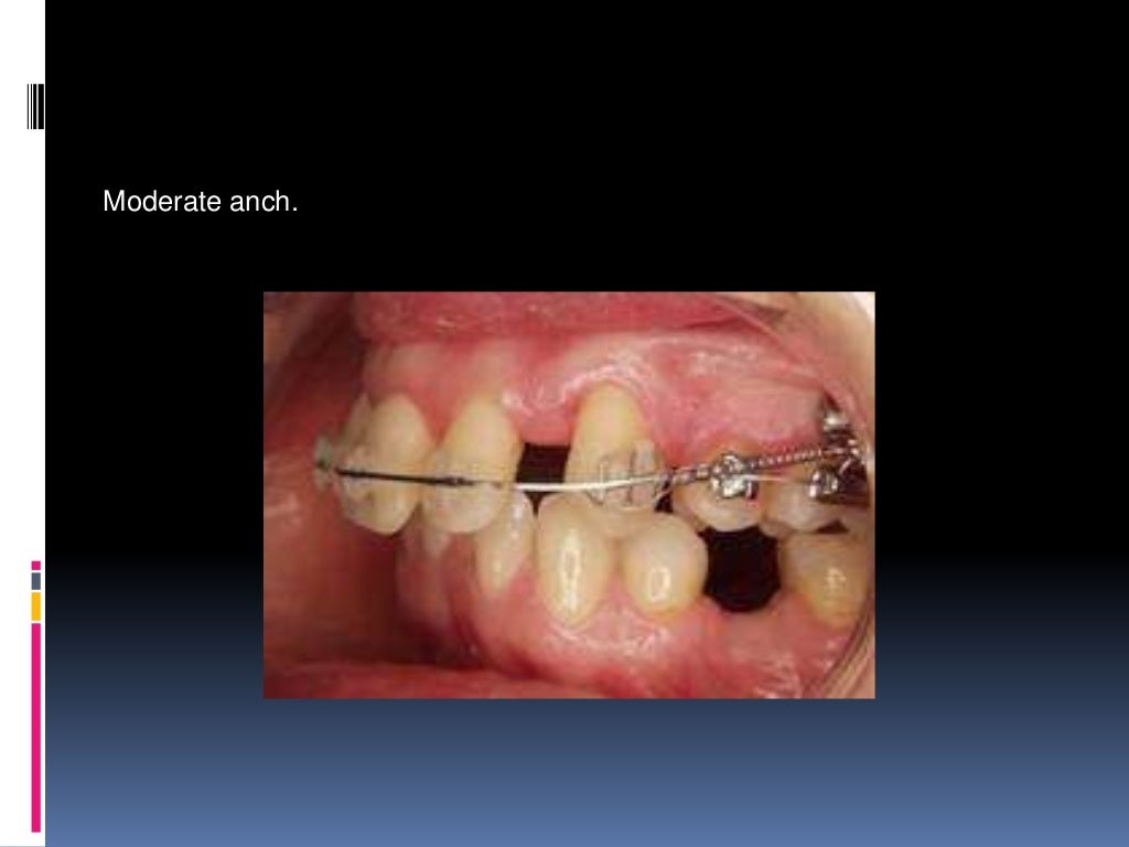 Orthodontic tooth movement ppt.