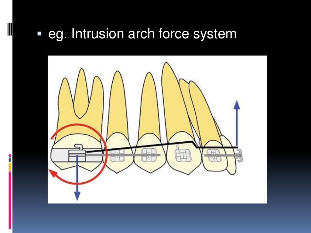 Orthodontic tooth movement ppt.