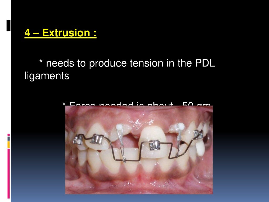 Orthodontic tooth movement ppt.
