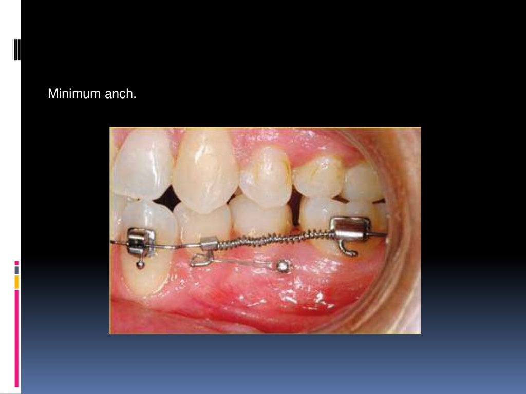 Orthodontic tooth movement ppt.