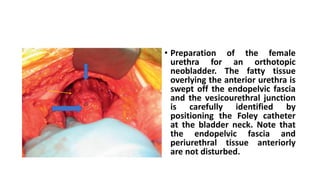 • Preparation of the female
urethra for an orthotopic
neobladder. The fatty tissue
overlying the anterior urethra is
swept off the endopelvic fascia
and the vesicourethral junction
is carefully identified by
positioning the Foley catheter
at the bladder neck. Note that
the endopelvic fascia and
periurethral tissue anteriorly
are not disturbed.
 