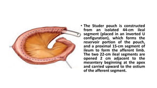 • The Studer pouch is constructed
from an isolated 44-cm ileal
segment (placed in an inverted U
configuration), which forms the
reservoir portion of the pouch,
and a proximal 15-cm segment of
ileum to form the afferent limb.
The two 22-cm ileal segments are
opened 2 cm adjacent to the
mesentery beginning at the apex
and carried upward to the ostium
of the afferent segment.
 