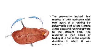 • The previously incised ileal
mucosa is then oversewn with
two layers of a running 3-0
polyglycolic acid suture starting
at the apex and running upward
to the afferent limb. The
reservoir is then closed by
folding it in half in the opposite
direction to which it was
opened.
 