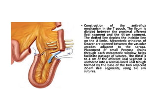 • Construction of the antireflux
mechanism in the T pouch. The ileum is
divided between the proximal afferent
ileal segment and the 44-cm segment.
The dotted line depicts the incision line
on the U limbs. Mesenteric windows of
Deaver are opened between the vascular
arcades adjacent to the serosa.
Placement of small Penrose drains
through each mesenteric window helps
facilitate passage of sutures. The distal 3
to 4 cm of the afferent ileal segment is
anchored into a serosal-lined ileal trough
formed by the base of the two adjacent
22-cm ileal segments, using 3-0 silk
sutures.
 