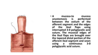 • A mucosa-to mucosa
anastomosis is performed
between the ostium of the
afferent segment and the edges
of the ileal flaps using
interrupted 3-0 polyglycolic acid
suture. The mucosal edges of
the ileal flaps are brought over
the tapered distal portion of the
afferent ileal segment and sewn
using a continuous 3-0
polyglycolic acid suture.
 