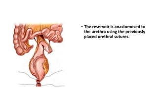 • The reservoir is anastomosed to
the urethra using the previously
placed urethral sutures.
 