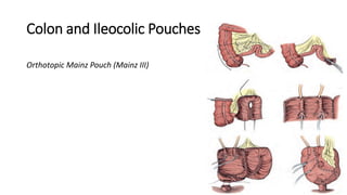 Colon and Ileocolic Pouches
Orthotopic Mainz Pouch (Mainz III)
 
