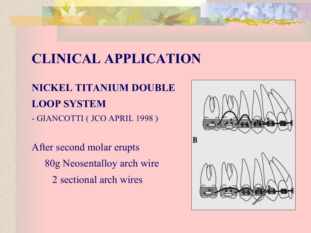Ortho wires part iii