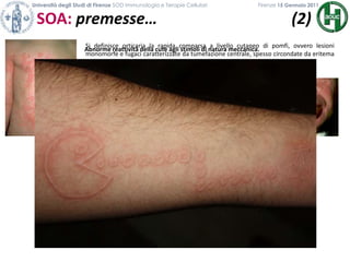 Università degli Studi di Firenze SOD Immunologia e Terapie Cellulari             	           Firenze 15 Gennaio 2011SOA: premesse…                                  (2)                                           Si definisce orticaria la rapida comparsa a livello cutaneo di pomfi, ovvero lesioni monomorfe e fugaci caratterizzate da tumefazione centrale, spesso circondate da eritema ed associate a prurito.Il pomfo è dovuto ad edema del derma superficiale.Abnorme reattività della cute agli stimoli di natura meccanica.Dal punto di vista istologico l’angioedema è contraddistinto da edema e dilatazione delle venule post-capillari e dei linfatici del derma profondo e del sottocute.  