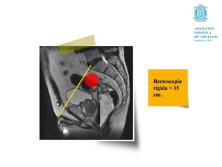 Rectoscopia
rígida < 15
cm.
 