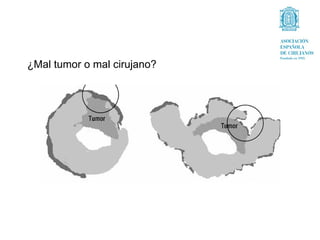 ¿Mal tumor o mal cirujano?
 