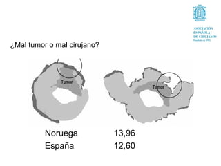 ¿Mal tumor o mal cirujano?




          Noruega            13,96
          España             12,60
 