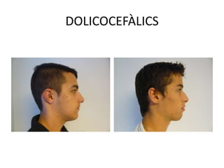 DOLICOCEFÀLICS