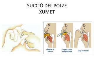 SUCCIÓ DEL POLZEXUMET