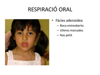 RESPIRACIÓ ORALFàcies adenoideaBoca entreobertaUlleres marcadesNas petit