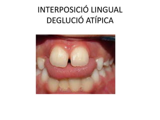 INTERPOSICIÓ LINGUALDEGLUCIÓ ATÍPICA