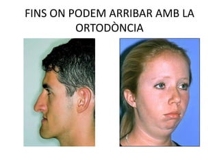FINS ON PODEM ARRIBAR AMB LA ORTODÒNCIA