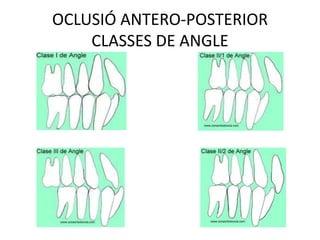 OCLUSIÓ ANTERO-POSTERIORCLASSES DE ANGLE