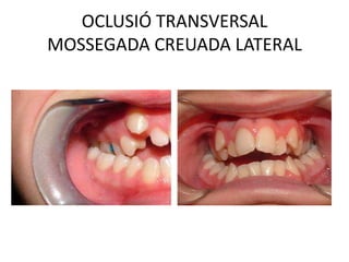 OCLUSIÓ TRANSVERSALMOSSEGADA CREUADA LATERAL