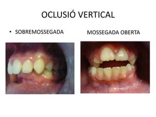OCLUSIÓ VERTICALSOBREMOSSEGADAMOSSEGADA OBERTA