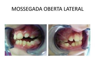 MOSSEGADA OBERTA LATERAL