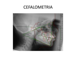 CEFALOMETRIA
