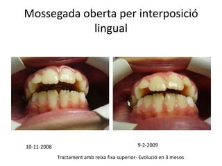 Mossegada oberta per interposició lingual9-2-200910-11-2008Tractament amb reixa fixa superior- Evolució en 3 mesos