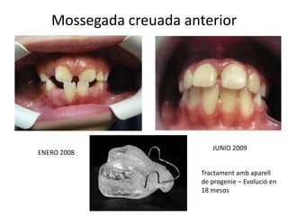 Mossegada creuada anteriorJUNIO 2009ENERO 2008Tractament amb aparell de progenie – Evolució en 18 mesos