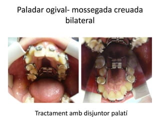 Paladar ogival- mossegada creuada bilateralTractament amb disjuntor palatí