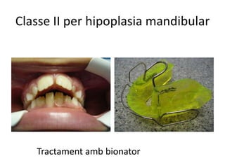 Classe II per hipoplasia mandibularTractament amb bionator