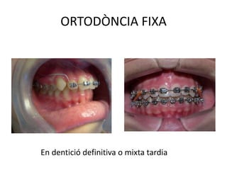ORTODÒNCIA FIXAEn dentició definitiva o mixta tardia