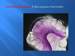 Ortodoncia elástica: Utiliza aparatos elásticos.
 
