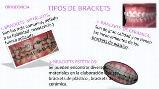TIPOS DE BRACKETSORTODONCIA
3. BRACKETS ESTÉTICOS:
Se pueden encontrar diversos
materiales en la elaboración de este,
brackets de plástico , brackets de
cerámica.
 