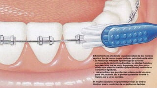 El tratamiento de ortodoncia se puede realizar de dos maneras
según el tipo de fuerzas que se apliquen, principalmente están:
• La técnica fija mediante aparatología fija que está
compuesta de elementos adheridos a los dientes (bandas y
brackets) a los que se ancla firmemente unos finos arcos
elásticos de aleación metálica (níquel-titanio) mediante un
conjunto de ligaduras..
• Los removibles, que permiten ser retirados de la boca por
parte del paciente. Ello le permite quitárselos durante la
higiene oral y en las comidas.
En muchas ocasiones los pacientes precisan de ambas
técnicas para la resolución de sus problemas dentales.
 
