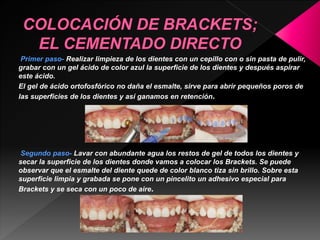 Primer paso- Realizar limpieza de los dientes con un cepillo con o sin pasta de pulir, 
grabar con un gel ácido de color azul la superficie de los dientes y después aspirar 
este ácido. 
El gel de ácido ortofosfórico no daña el esmalte, sirve para abrir pequeños poros de 
las superficies de los dientes y así ganamos en retención. 
Segundo paso- Lavar con abundante agua los restos de gel de todos los dientes y 
secar la superficie de los dientes donde vamos a colocar los Brackets. Se puede 
observar que el esmalte del diente quede de color blanco tiza sin brillo. Sobre esta 
superficie limpia y grabada se pone con un pincelito un adhesivo especial para 
Brackets y se seca con un poco de aire. 
 