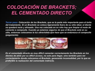 Tercer paso- Colocación de los Brackets, que es la parte más importante para el éxito 
del tratamiento. Si un Brackets se coloca ligeramente fuera de su sitio ideal, el diente 
no quedará recto y alineado. Una vez colocado en su sitio hay que limpiar el resto de 
cemento o composite. Cuando ya estamos seguros de que el Brackets está en su 
sitio, entonces colocamos la luz ultravioleta que hace que se endurezca el composite 
(pegamento). 
En el cementado directo es muy difícil cementar correctamente los Brackets en los 
dientes de atrás por su difícil acceso, no solo para llegar, sino también para ver 
correctamente donde colocamos el Brackets, generando incomodidad, por lo que es 
preferible la realización del cementado indirecto. 
 