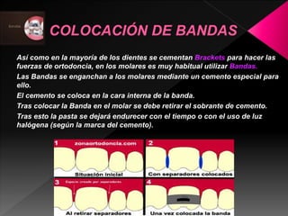 Así como en la mayoría de los dientes se cementan Brackets para hacer las 
fuerzas de ortodoncia, en los molares es muy habitual utilizar Bandas. 
Las Bandas se enganchan a los molares mediante un cemento especial para 
ello. 
El cemento se coloca en la cara interna de la banda. 
Tras colocar la Banda en el molar se debe retirar el sobrante de cemento. 
Tras esto la pasta se dejará endurecer con el tiempo o con el uso de luz 
halógena (según la marca del cemento). 
 