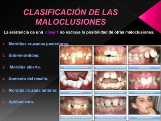 La existencia de una clase 1 no excluye la posibilidad de otras maloclusiones. 
1. Mordidas cruzadas posteriores. 
2. Sobremordidas. 
3. Mordida abierta. 
4. Aumento del resalte. 
5. Mordida cruzada anterior. 
6. Apiñamiento. 
 