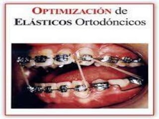 ARCO DE GOSHGARIAN-Se 
usa para expansionar, rotar y estabilizar molares. 
REJILLAS O RASTRILLO-Su 
función es reeducar há...