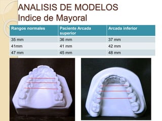 ANALISIS DE MODELOS
Indice de Mayoral
Rangos normales Paciente Arcada
superior
Arcada inferior
35 mm 36 mm 37 mm
41mm 41 mm 42 mm
47 mm 45 mm 48 mm
 