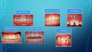 SOBRE MORDIDA
MORDIDA CRUZADA MORDIDA ABIERTA
LINEA MEDIA DESPLAZADA ESPACIAMIENTO
APIÑAMIENTO
 