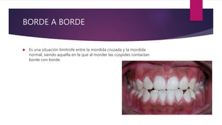 BORDE A BORDE
 Es una situación limítrofe entre la mordida cruzada y la mordida
normal, siendo aquella en la que al morder las cúspides contactan
borde con borde.
 