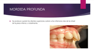 MORDIDA PROFUNDA
 Se produce cuando los dientes superiores cubren a los inferiores más de la mitad
de la pieza inferior, o totalmente.
 