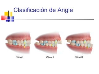Clasificación de Angle
 