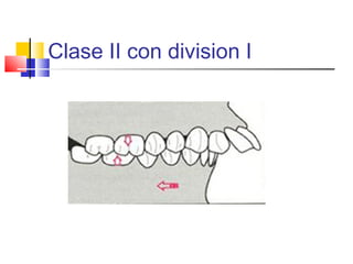 Clase II con division I
 