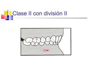 Clase II con división II
 