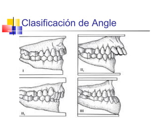 Clasificación de Angle
 