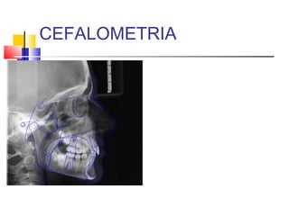 CEFALOMETRIA
 