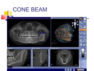 CONE BEAM
 