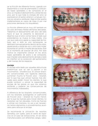 jar la fricción de diferente forma. Ligando con
elastómeros a nivel de premolares o colocan-
do topes apretables o de composite en el
arco, se impide el deslizamiento a distal de ese
arco, por lo que toda la energía del arco se
expresará en el sector anterior y el grupo inci-
sivo se volcará a vestibular. Algo similar podría
implementarse en casos de clase III por mal
posiciones dentarias (no esqueletal).

La fricción diferencial es muy útil también en
los caso de líneas medias dentarias desviadas.
Trabamos el deslizamiento del arco del lado              Mini tornillos con resorte Sentalloy
hacia el que se presenta la desviación y
dejamos que el arco corrija hacia el lado que
pretendemos se mueva la línea media. Una
vez que cada arco agote su capacidad de tra-
bajo, aún si éste es uno rectangular, se
deslizará transversalmente dentro de los slots,
apareciendo a distal de uno u otro tubo molar,
lacerando el carrillo o mejilla del paciente. Éste
es el momento de avanzar de arco. Por éste
motivo es importante colocar en los arcos
topes apretables de acero o de composite,
que impidan este deslizamiento de lado a lado
sin interferir en la corrección del apiñamiento           Mini tornillo con cadena elástica
y del manejo de los espacios.

Anclaje
El anclaje esta dado por aquellas estructuras
anatómicas que se van a oponer a los
movimientos ortodóncicos. El utilizar brack-
ets convencionales con ligaduras elásticas,
aumentan mucho la fricción arco – bracket,
por lo que hay que utilizar fuerzas mas ele-
vadas para poder mover los dientes, lo que
puede conducir a vencer la capacidad de
anclaje de las piezas en que nos estamos
anclando y padecer las consecuencias de
                                                         Resorte Sentalloy de molar a poste
movimientos indeseados.

A diferencia de los brackets convencionales,
con los brackets autoligantes el coeficiente
de fricción arco – bracket es mucho menor,
por lo que las fuerzas para mover dientes no
necesitan ser tan elevadas. Como las fuerzas
a utilizar son menores, no van a ser necesar-
ios tantos elementos o procedimientos auxil-
iares para reforzar el anclaje.

Se recomienda la utilización de resortes
Sentalloy con ojales, para el cierre de espa-
cios en el caso de extracciones. Al ser éstos            Resorte Sentalloy de molar a canino
manufacturados con diferentes cargas, sabe-                            Fig. 15

                                                     9
 